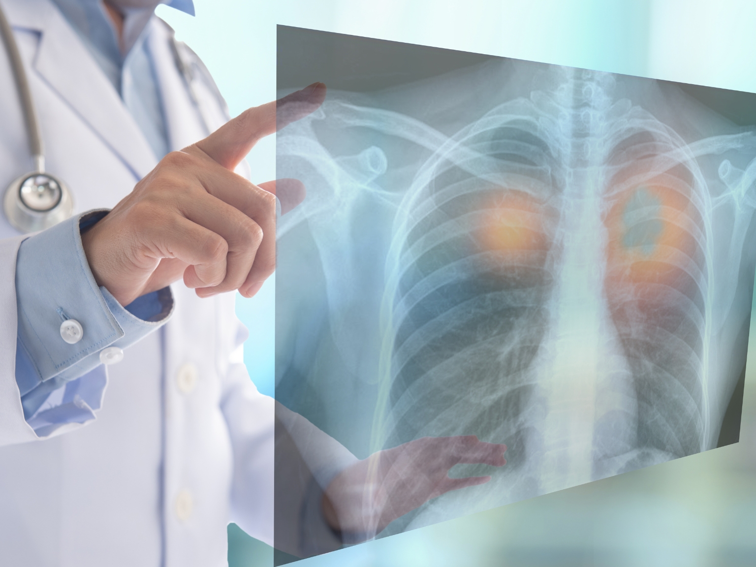 Cancerul pulmonar – Prevenirea, Detectarea Timpurie și Rolul Stilului de Viață Sănătos